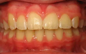 Smiles by Smith Case 6 after