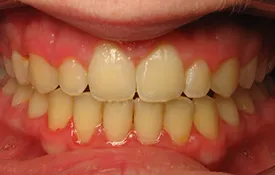 Smiles by Smith Case 5 after